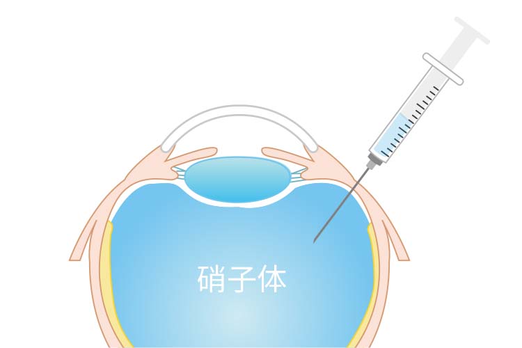 硝子体注射