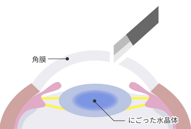 角膜を切開します