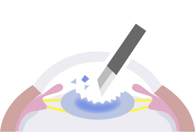 濁った水晶体を取り除く