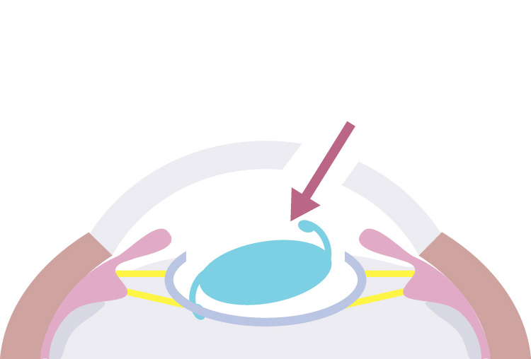 眼内レンズを入れる