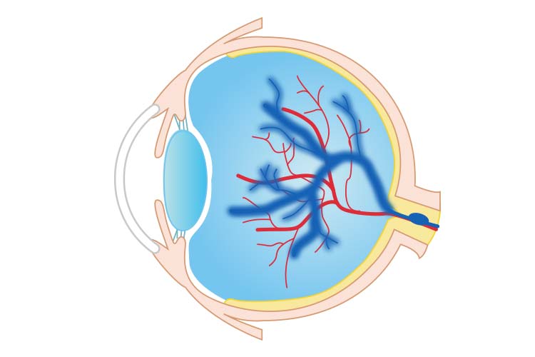 網膜静脈閉塞症